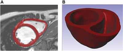 Investigating the Role of Interventricular Interdependence in Development of Right Heart Dysfunction During LVAD Support: A Patient-Specific Methods-Based Approach